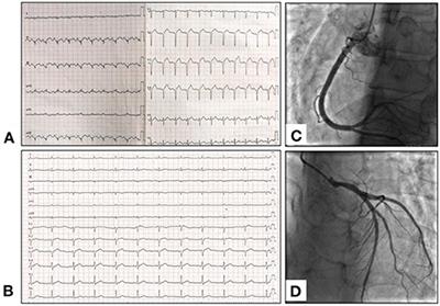 Case Report: Area of Focus of Myocardial Infarction With Non-obstructive Coronary Arteries in Eosinophilic Granulomatosis With Polyangiitis